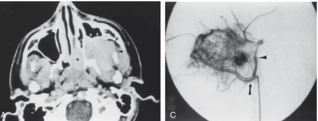 Gambar  4.  Angiogram  menggambarkan  angiofibroma  sebelum  dan  sesudah  embolisasi,  suplai darah tumor dari arteri maxillaris interna
