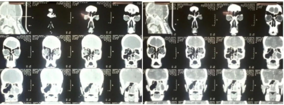 Gambar 10. Pemeriksaan CT scan 