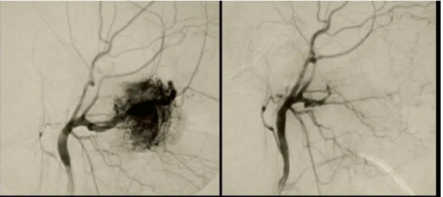 Gambar 3. Angiogram menggambarkan angiofibroma sebelum dan sesudah embolisasi, suplai darah tumor dari  arteri maxillaris interna 