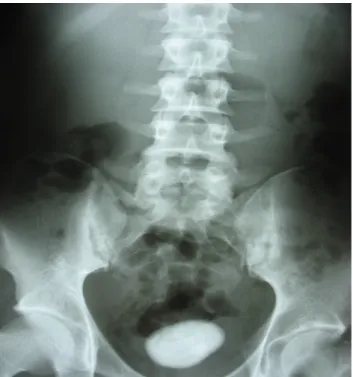 Gambar 6. Gallstone Ileus (Foto CT Scan dengan Multipel Batu Empedu Tidak Diperlihatkan
