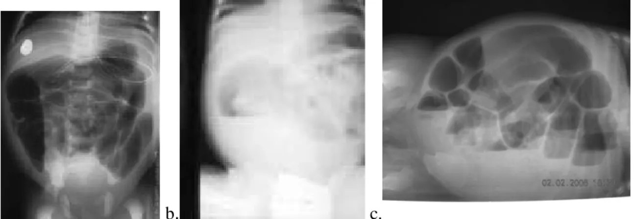 Gambar 4. Foto polos abdomen penderita Hirschsprung disease posisi AP-supine: gb a tampak dilatasi pada sistema usus dan gambaran feses (mottled appearance di proksimal) dan tak tampak gambaran udara/feses di bagian distal (di rongga pelvis-rektum dan sigm