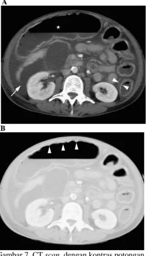 Gambar 7. CT scan dengan kontras potongan aksial wanita berusia 52 tahun dengan megakolon toksik akibat kolitis akut yang berat karena kolitis pseudomembranosa.