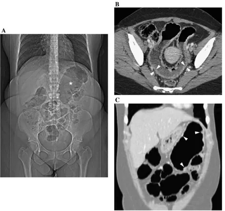 Gambar 9. CT scan wanita berusia 35 tahun dengan megakolon toksik komplikasi kolitis akut berat karena kolitis ulseratif