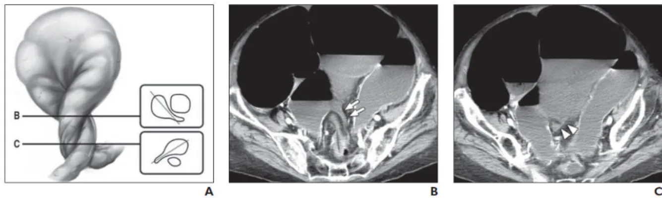 Gambar 13. Foto dari pemeriksaan barium enema pada posisi supine memperlihatkan bird’s beak (panah putih) pada lokasi puntiran kolon sigmoid