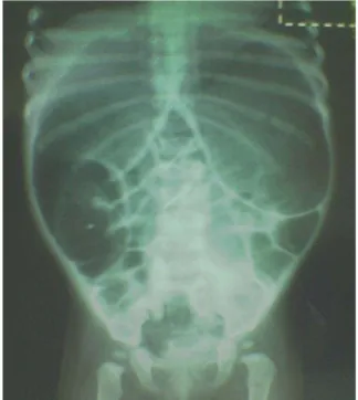 Gambar 1. Foto polos abdomen pada neonatus  dengan penyakit hirschprung 