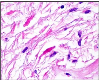 Gambar 2.7. Gambaran histopatologi dari astrositoma pilositik (WHO grade I)  Sumber: Brain Tumor Research, 2008