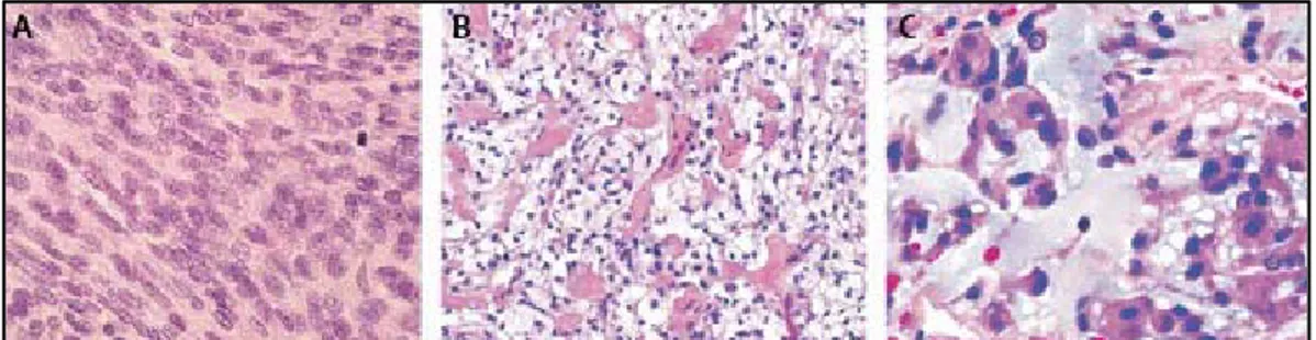 Gambar 2.12. Gambaran histopatologi berbagai varian meningioma WHO grade  II: meningioma atipikal (A), clear-cell  (B), dan chordoid  (C)