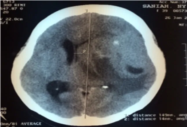 Gambar 1. CT scan menujukkan masa pada  daerah temporoparietal kiri dengan pergeseran  midline dan perdarahan intratumoral