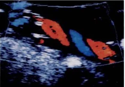 Gambar 11. Umbilical cord coiling Color Doppler image shows a normally  coiled umbilical cord