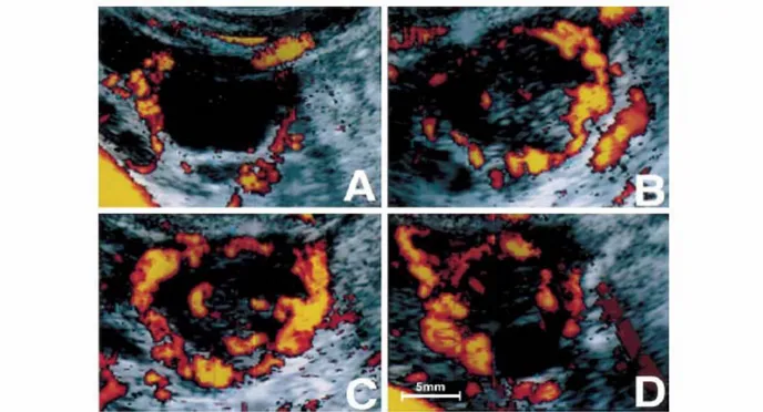 Gambar . Aliran Darah ( Angiogenesis ) Corpus Luteum Di Dalam Ovarium Pada USG Doppler  Transvaginal 