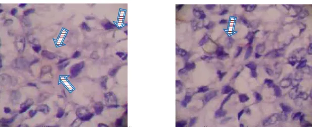 Gambar  2.  Hasil  pengecatan  IHC  dengan  Mo  Ab  α-pRb pada  Adenokarsinoma  prostat (kiri) dan BPH (kanan)