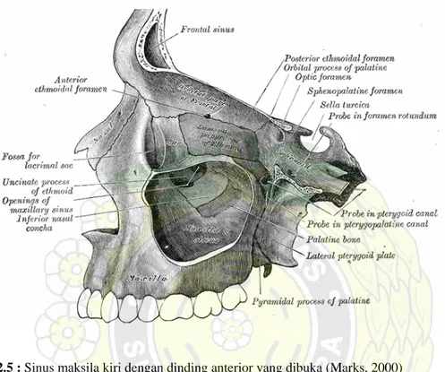 Gambar 2.5 : Sinus maksila kiri dengan dinding anterior yang dibuka (Marks, 2000) 