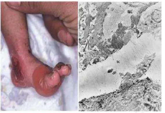 Gambar 4. Epidermolisis Bulosa Simpleks Tipe Dowling-Meara dan gambaran  mikroskop elektronnya pada bayi 18 bulan  (9)   
