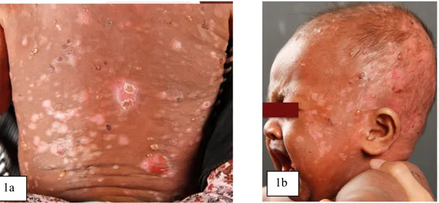 Gambar 1a dan b. Gambaran klinis menunjukkan bula tegang multipel dalam berbagai ukuran di atas kulit  normal atau patch hiperpigmentasi.