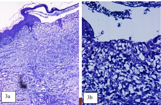 Gambar 4a dan b. Pemeriksaan histopatologi dengan pewarnaan toluidin blue menunjukkan bula subepidermal dengan  peningkatan infiltrasi  difus  sel  mast  di  dermis