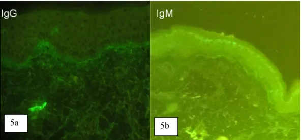Gambar 5a &amp; b. Pemeriksaan imunofluoresensi langsung menunjukkan deposit IgG dan IgM linear di membran basalis