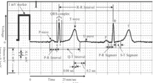 Gambar 1. Sinyal QRS Kompleks  Orang Normal 