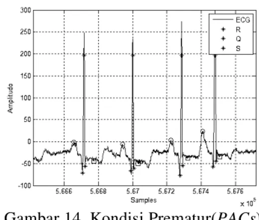 Gambar 14. Kondisi Prematur(PACs)  sinyal 100.dat pada durasi 26.09 menit    Tabel  1