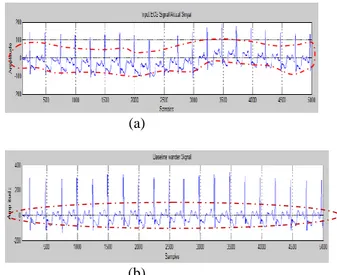 Gambar 3.3. Sinyal ECG Asli untuk Data  117m.mat(bentuk ECG yang besar dan lebar)(a)  dan Sinyal ECG Hasil Baseline Wander  Removal(b) 