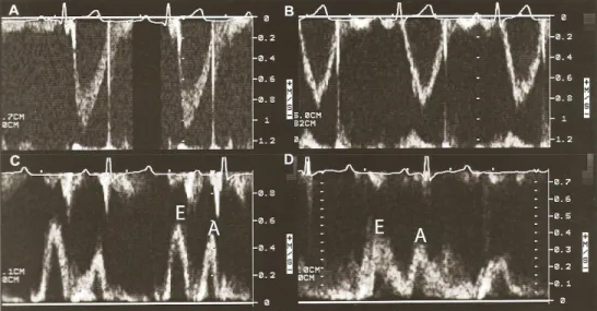 Gambar  3.  Hasil  scan  pulsed  wave  Doppler  dan  EKG  anjing  normal:  (A)  Ditujukan  untuk  katup  Ao  (Posisi  transducer  LAp),  (B)  Ditujukan  untuk  Pulmonum (Posisi transducer RPS), (C) Ditujukan untuk katup  mitralis  (Posisi  transducer  LAp)