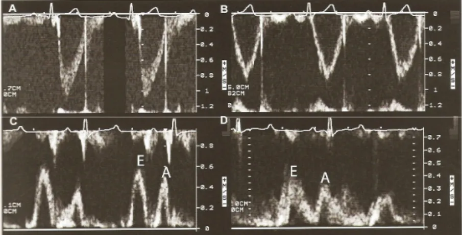 Gambar 2A. Hasil scan pulse wave Doppler dan EKG anjing normal: (A) ditujukan untuk katup  Ao  (posisi transduser LAp),  (B)  ditujukan  untuk Pulmonum  (posisi transduser RPS),  (C)  ditujukan  untuk  katup  mitralis (posisi transduser LAp), dan (D) dituj