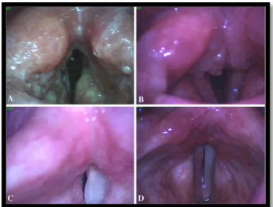 Gambar  2.  Hasil  pemeriksaan  laringoskopi  pada  TB  laring  (A)  Tipe  ulseratif,  pada  rongga  laring  (B)  Tipe  granulomatosa,  pada  bagian  posterior  glotis  (C)  Tipe  polipoid,  pada  pita  suara  palsu  kanan  (D)  Tipe  nonspesifik, pada pit