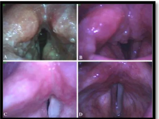Gambar 3. Hasil pemeriksaan laringoskopi pada  tuberkulosis laring (A) Tipe ulseratif, pada rongga laring  (B) Tipe granulomatosa, pada bagian posterior glotis (C)  Tipe polipoid, pada pita suara palsu kanan (D) Tipe  nonspesifik, pada pita suara kanan 7