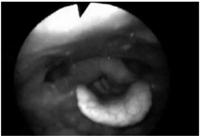 Gambar 8. Aritenoidektomi dekstra dan kordektomi  posterior intralaring