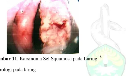 Gambar 11. Karsinoma Sel Squamosa pada Laring  18  4.  Gangguan Neurologi pada laring 