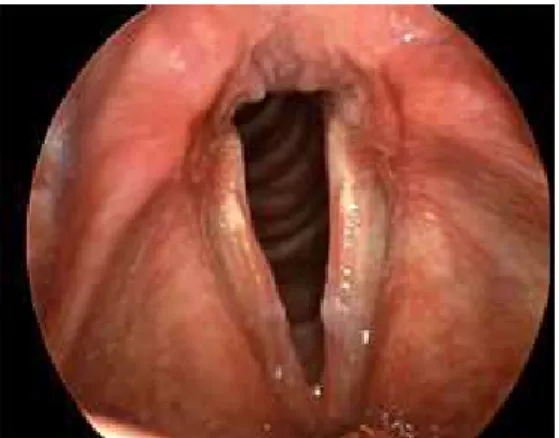 Gambar 6. Gambaran laring dan pita suara pada laringitis 9