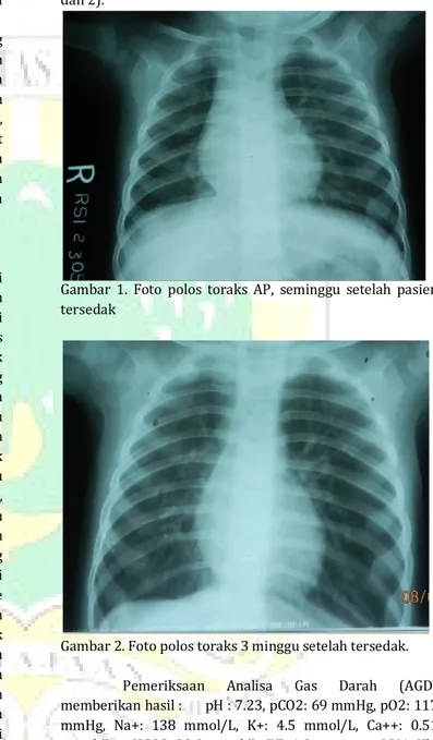 Gambar  1.  Foto  polos  toraks  AP,  seminggu  setelah  pasien  tersedak 