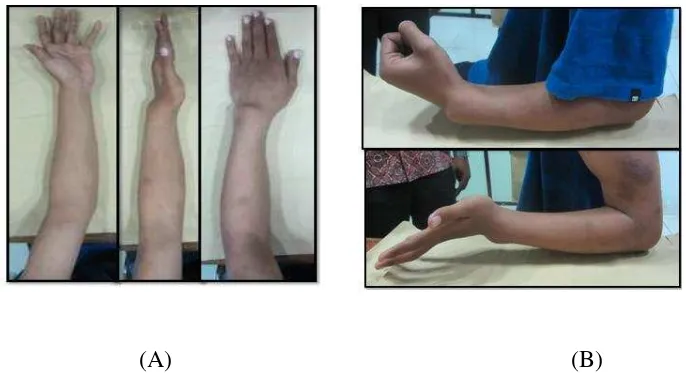 Figure 1. (A) shows the clinical picture pre operative with deformity angulation and 