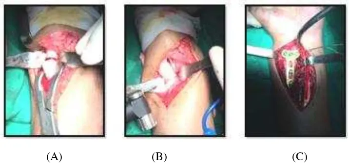 Figure 2. Shows the clinical picture pre operative with restricted supination-pronation 