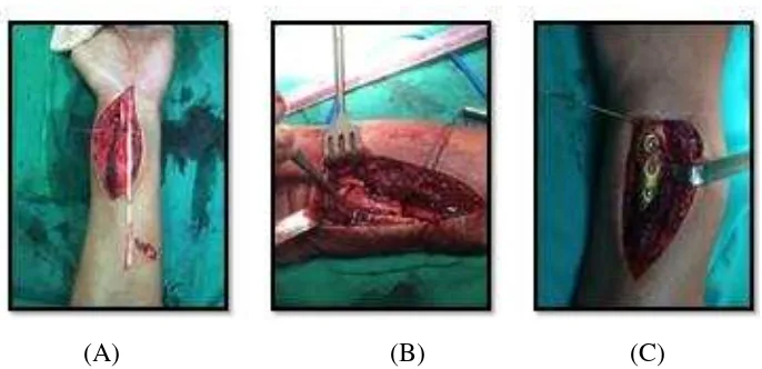 Figure 4. (A) show the Palmaris longus tendon as a graft for stabilization distal 
