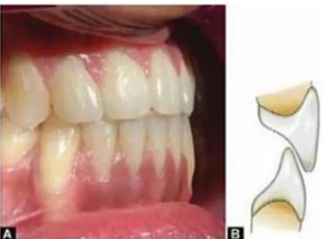 Gambar 5. Inklinasi gigi anterior rahang atas dan rahang bawah. A. Inklinasi normal. B