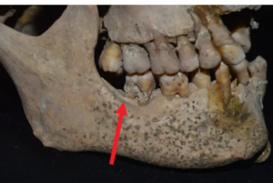 Gambar 2. Karies Pada Akar Gigi Molar  Kedua Mandibula Kanan Individu III 