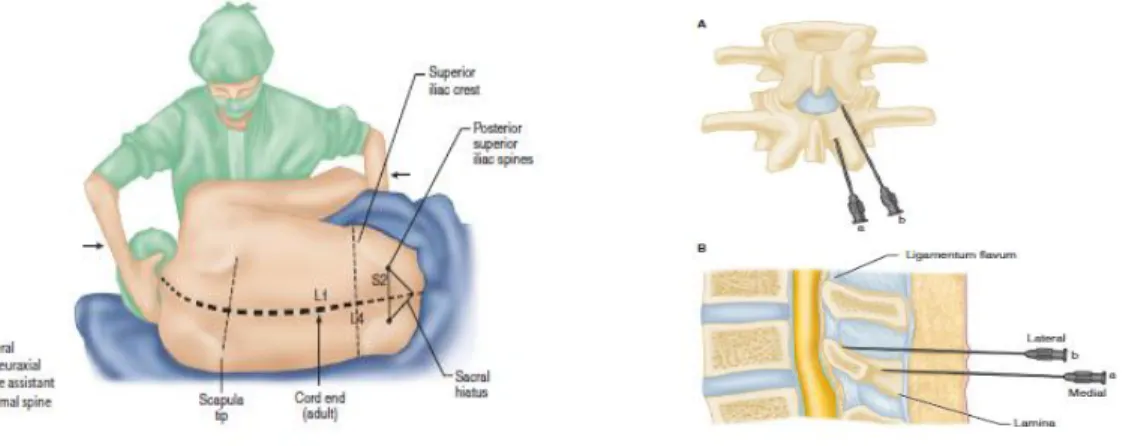 Gambar 3. Anatomi Anestesi Spinal dan Lapisan Tulang Vertebra   Saat Tindakan Anestesi Spinal 58 