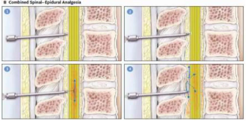 Gambar 2.8 Analgesia kombinasi spinal dan epidural 