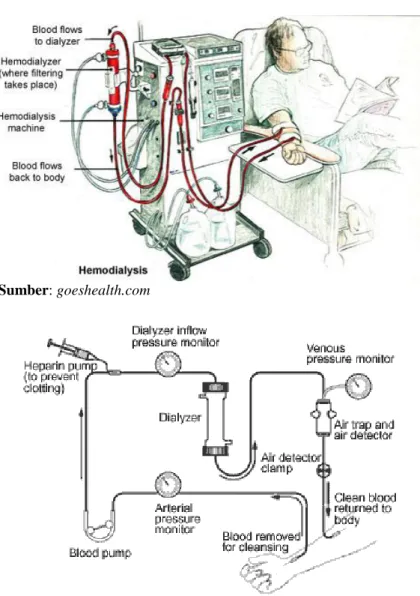 Gambar 4. Mekanisme hemodialisis 