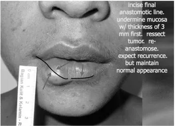 Gambar  10.  Desain  “subterranean  d issection”  untuk  lesi neurofibroma di bibir bawah kanan.