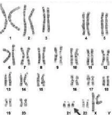 Gambar 4. Kelainan kromosom trisomi 21 (Suryo,2010)  Gambar 8. Kelainan kromosom trisomi 21 (Suryo,2010)
