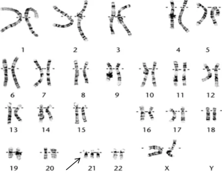 Gambar 2. Kromosom penderita sindrom Down. 22