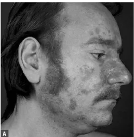 Gambar 1.  Lesi DS di wajah dan dada pada penderita  HIV/AIDS. 1
