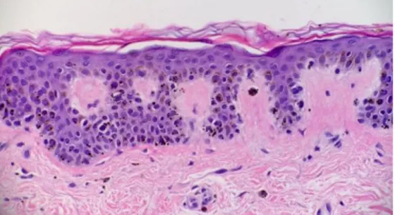 Gambar 4. Gambaran Makromelanosom pada  Lesi Café-au-lait  Diunduh dari:   http://dermaamin.com/site/histopathology-of- the-skin/65-m/1902-macromelanosomes---.html 22 Maret 2017  B
