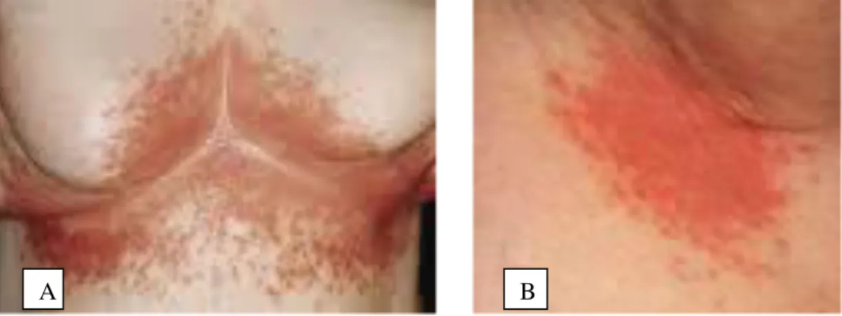 Gambar 2.1  Kandidosis intertriginosa: A pada area inframama, B lesi di bawah ketiak 
