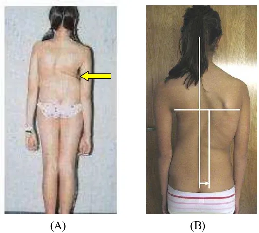Gambar 22. (A) Tampak posterior dari pasien dengan scoliosis. Tampak 