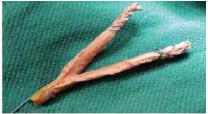 Table 1. Comparison Type of Graft in Reconstruction Anterior Cruciate Ligament 