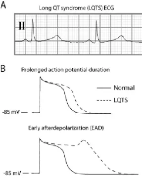 Gambar 3. Long QT syndrome (LQTS). A: Gambaran EKG LQTS. B: Potensial aksi yang memanjang  pada LQTS serta terbentuknya early after depolarization