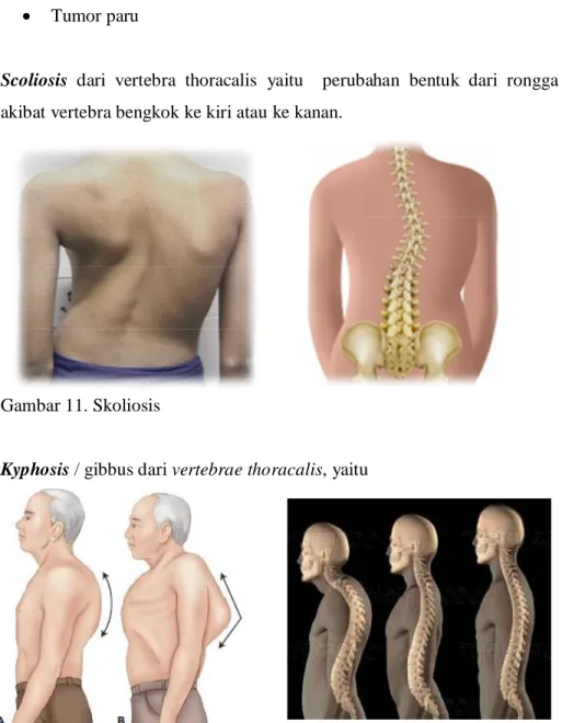 Gambar 11. Skoliosis 