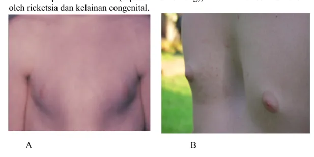 Gambar .A.  Flat chest, B. Barrel chest 